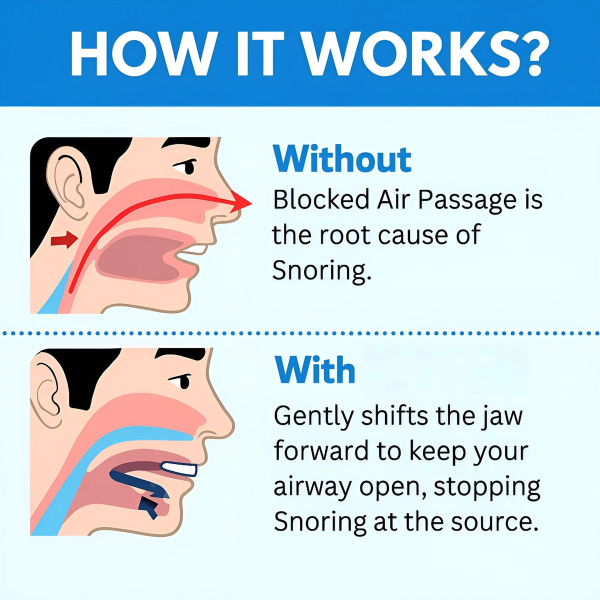 Vivoracare  Anti Snoring Mouthpiece